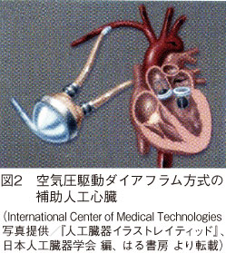 図2　空気圧駆動ダイアフラム方式の補助人工心臓